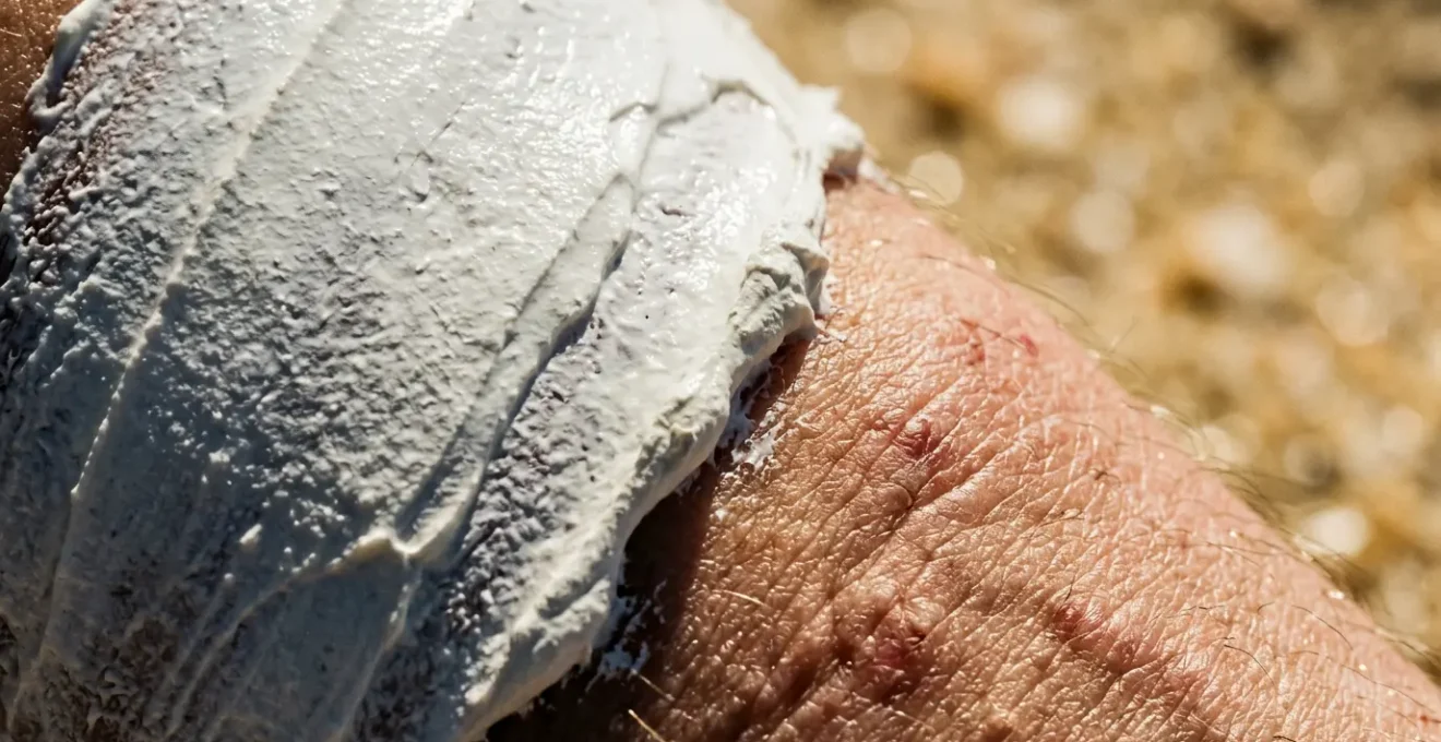 Zone de peau cicatricielle protégée contre les rayons UV intenses avec application de barrière protectrice