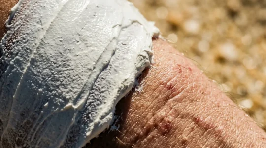 Zone de peau cicatricielle protégée contre les rayons UV intenses avec application de barrière protectrice