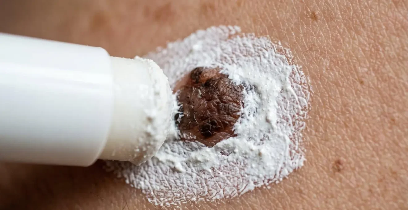 Application d'un stick de protection minérale épaisse sur un grain de beauté en relief